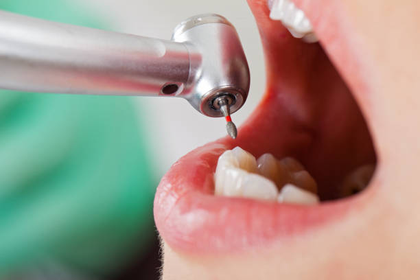 Best Emergency Tooth Extraction in Ballard, UT